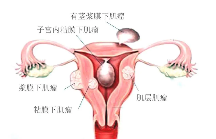 【旦旦医学知识科普】什么是子宫肌瘤