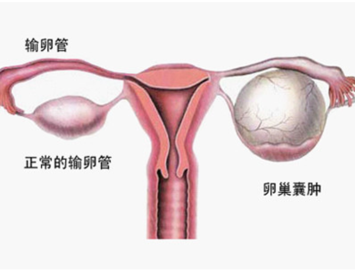 卵巢囊肿是怎么引起的?常见原因有哪些？