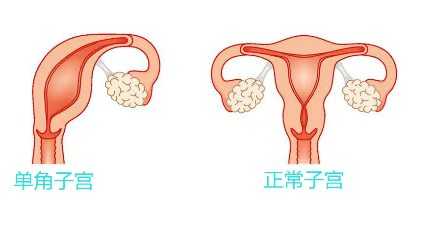 什么是单角子宫，得了这个还能怀孕吗？