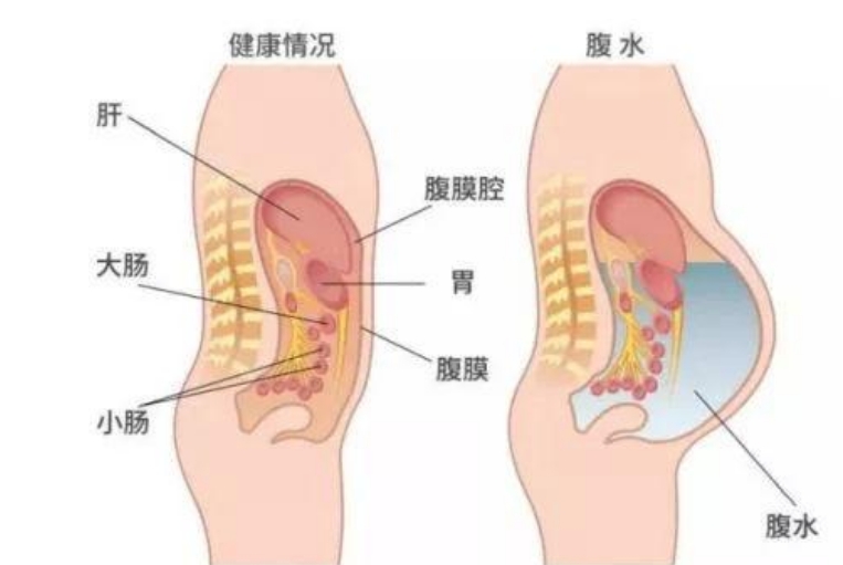 取卵腹水外阴肿了多久消失,和积液有什么区别?