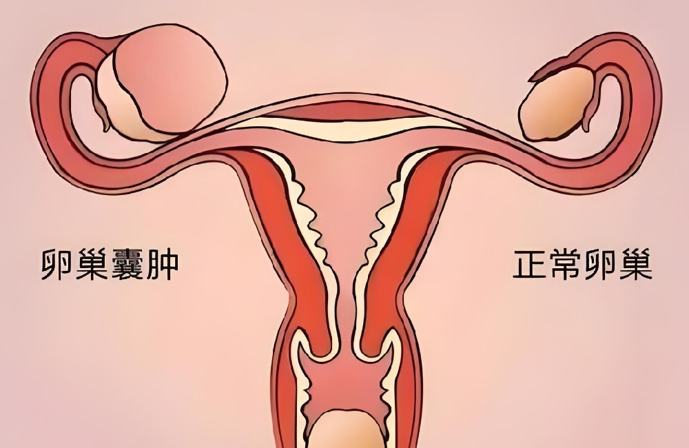 卵巢囊肿平时怎么保养？多吃这些食物！