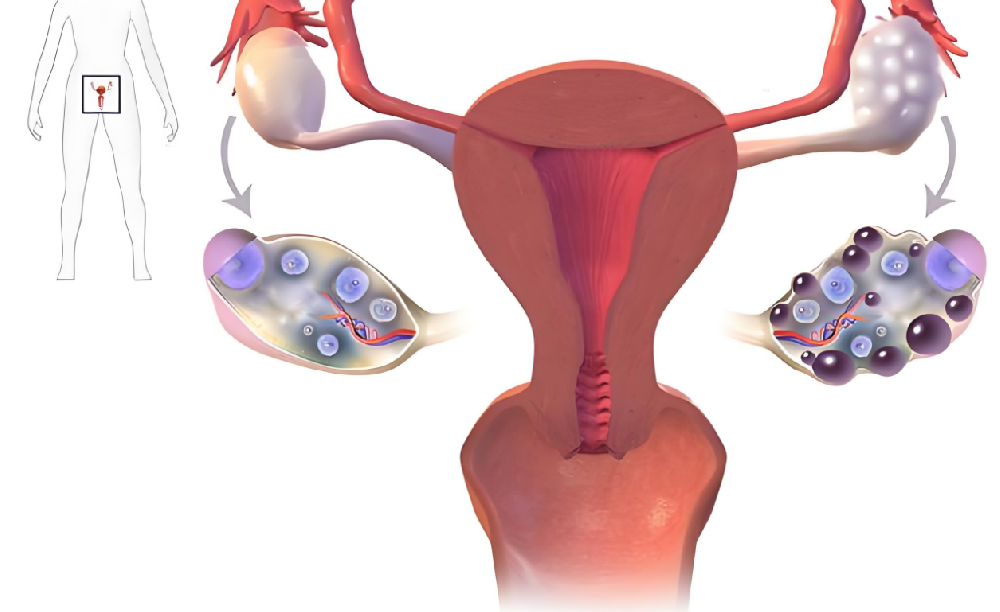 双侧多囊卵巢综合征是什么？